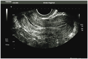 ecografia ginecológica