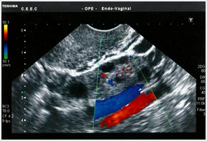 Ecografia ginecológica com Doppler